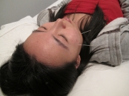 Painless acupuncture (Weight loss, dizziness, fatigue, skin problems treatment in Torrance and Fullerton)